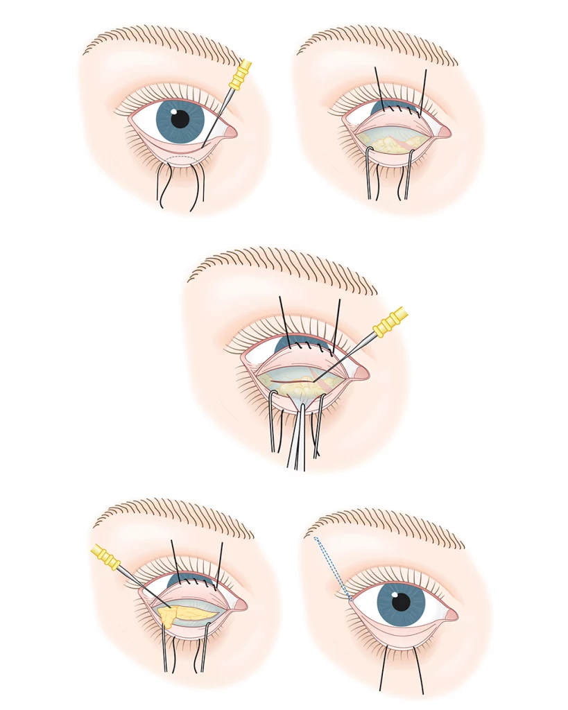 برش ملتحمه در بلفاروپلاستی(belpharoplasty)